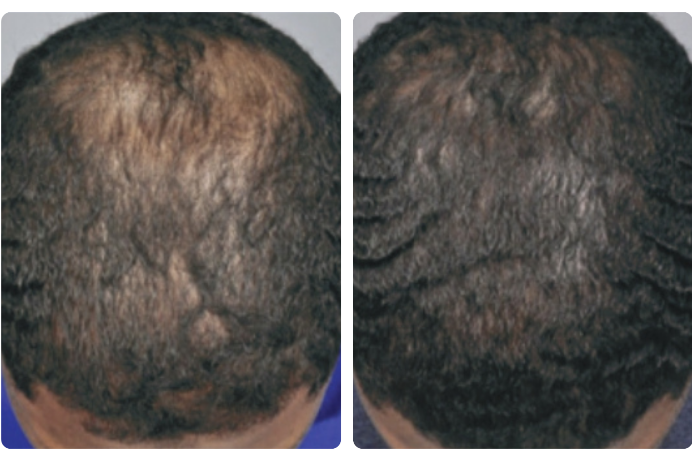 Crown density improvement