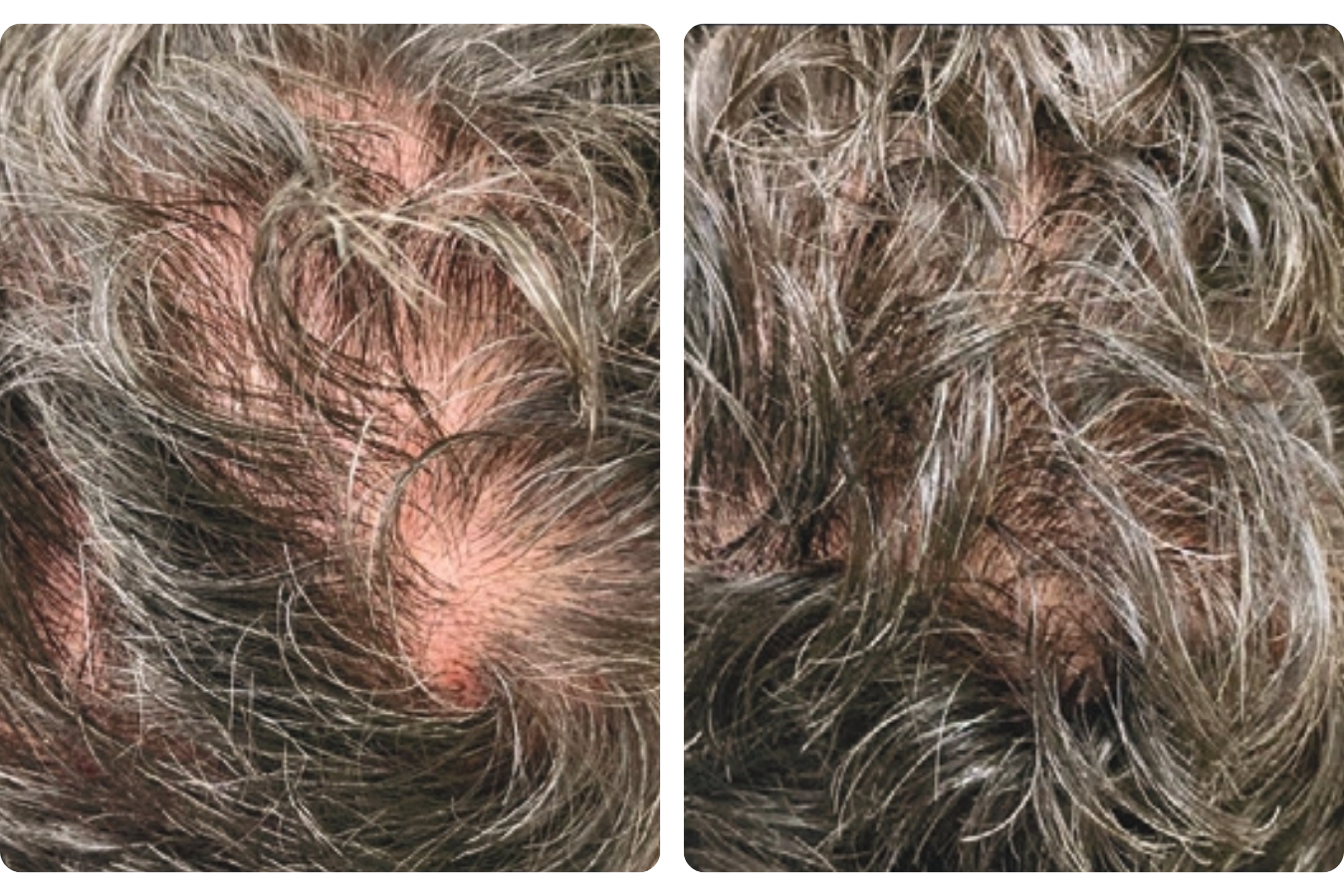Hairline thickening